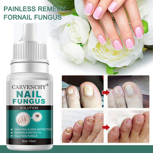 Nail Fungus Oil